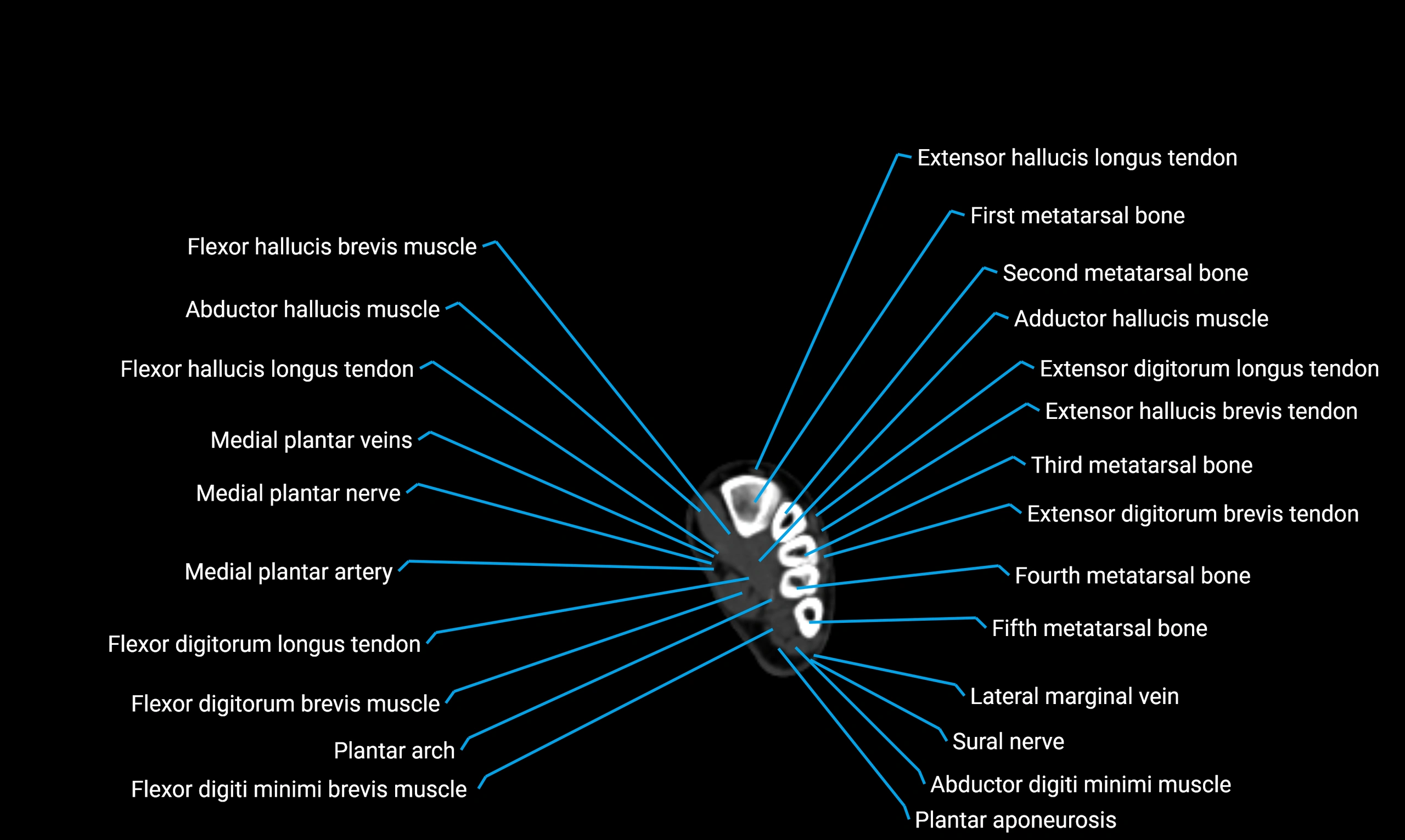 CT lower limb axial cross sectional anatomy labelled image 184 (2).webp